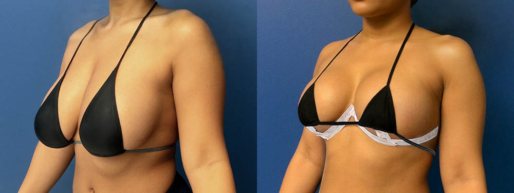 Breast Lift Before and After in Miami