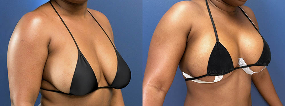 Breast Reduction Before and After
