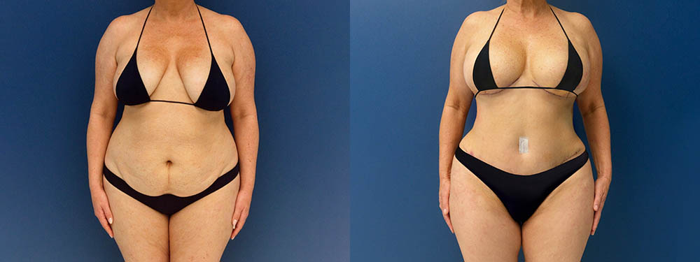 Mommy Makeover Before and After