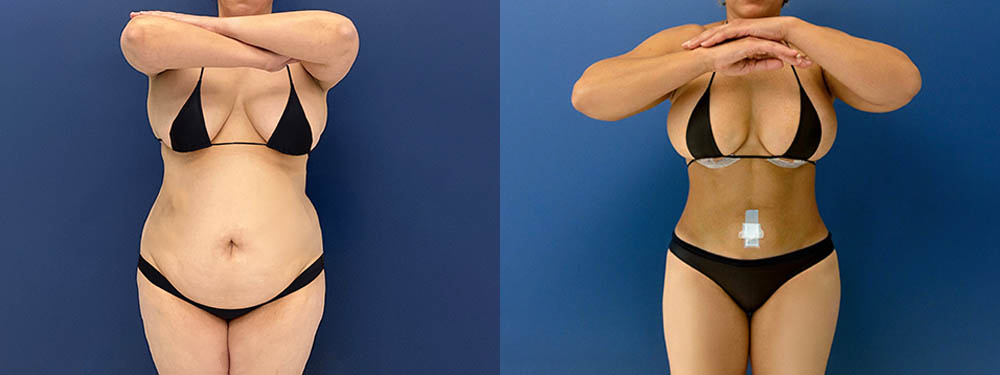 Mommy Makeover Before and After