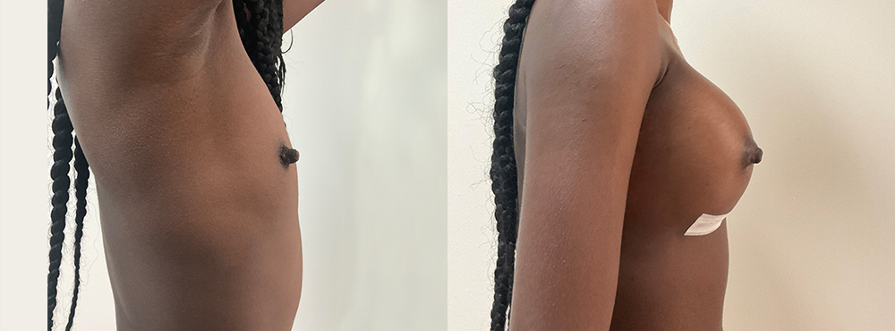 Breast Augmentation Before and After