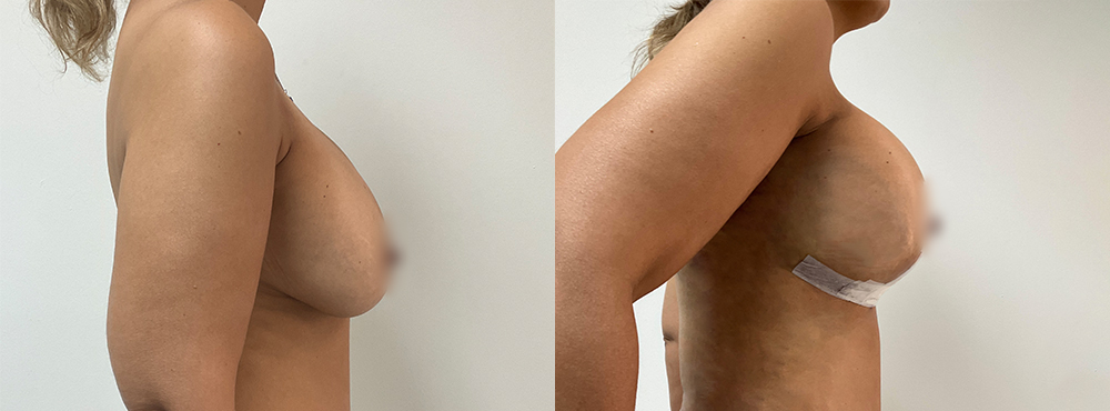 Breast Lift  Before and After