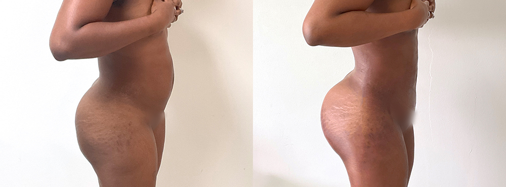 BBL Before and After