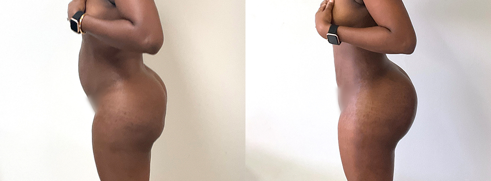 BBL Before and After