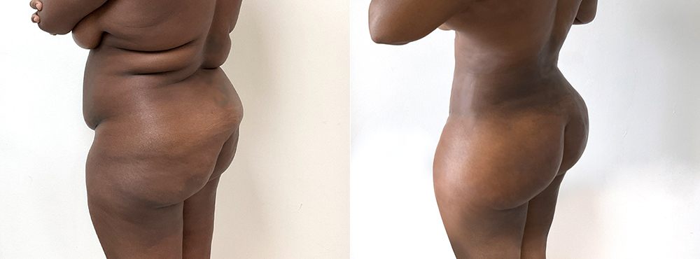 BBL Before and After