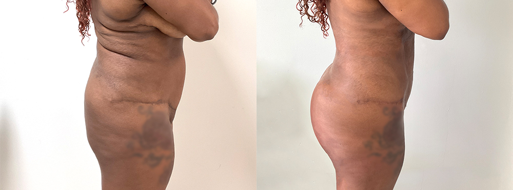 BBL Before and After