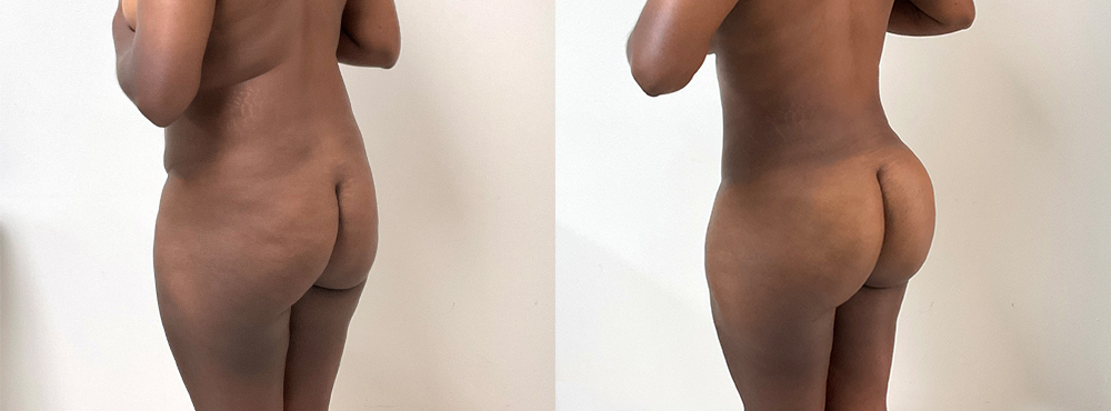 BBL Before and After