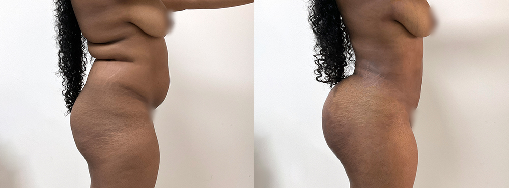 BBL Before and After