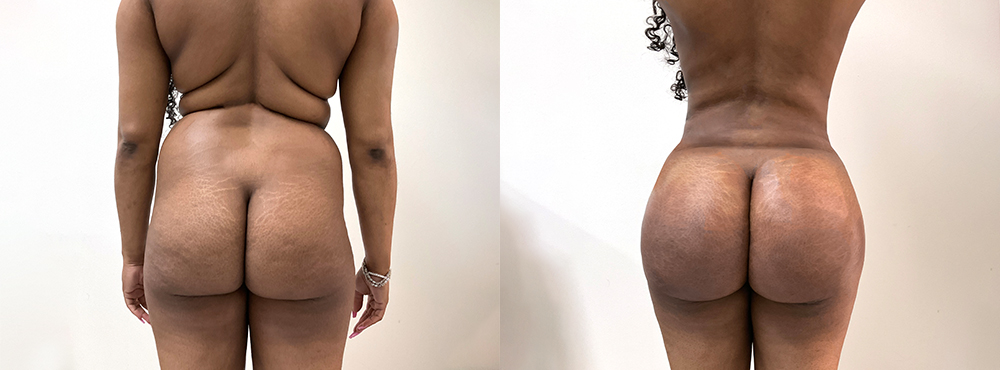 BBL Before and After