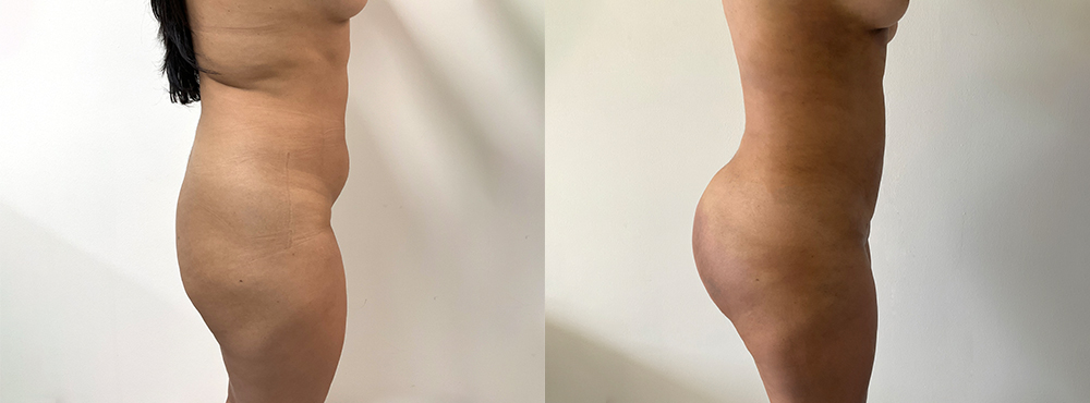 BBL Before and After