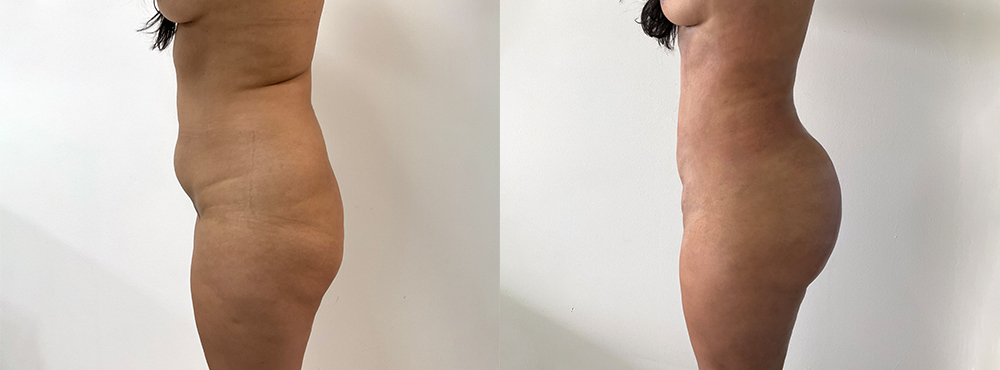 BBL Before and After