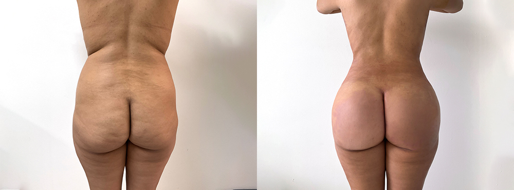 BBL Before and After