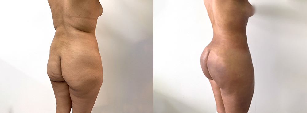 BBL Before and After