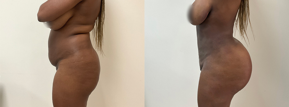 BBL Before and After