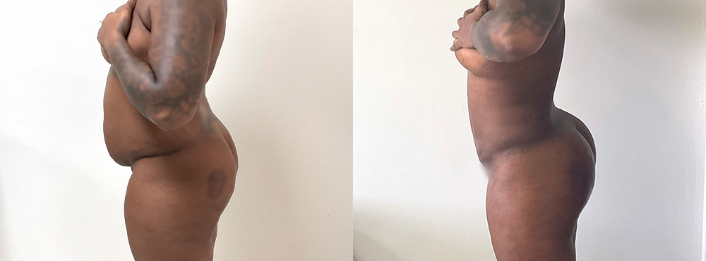 BBL Before and After