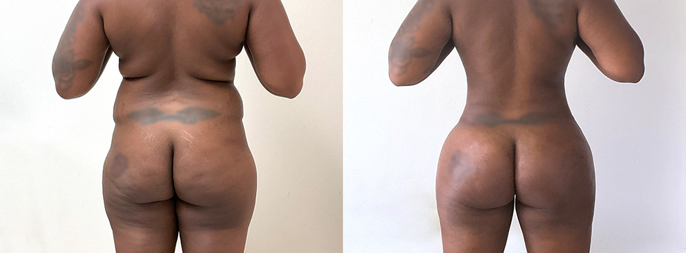 BBL Before and After