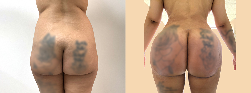 BBL Before and After