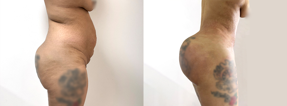 BBL Before and After