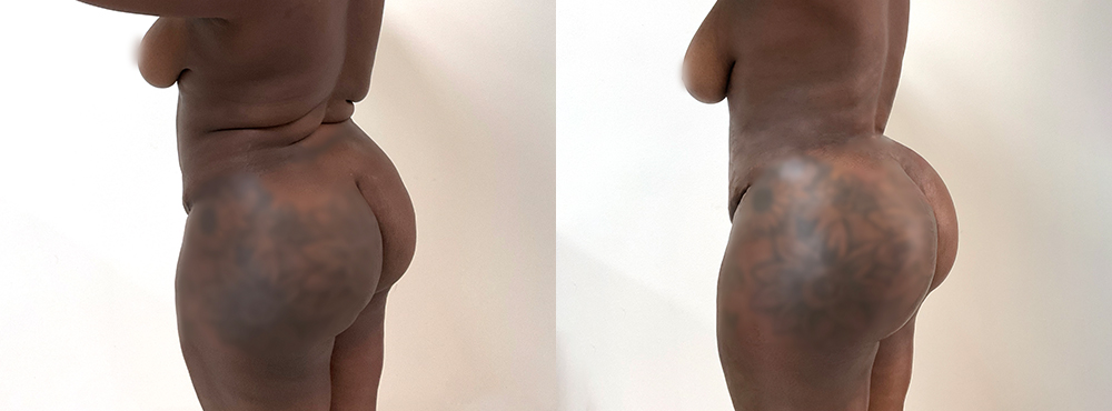 BBL Before and After