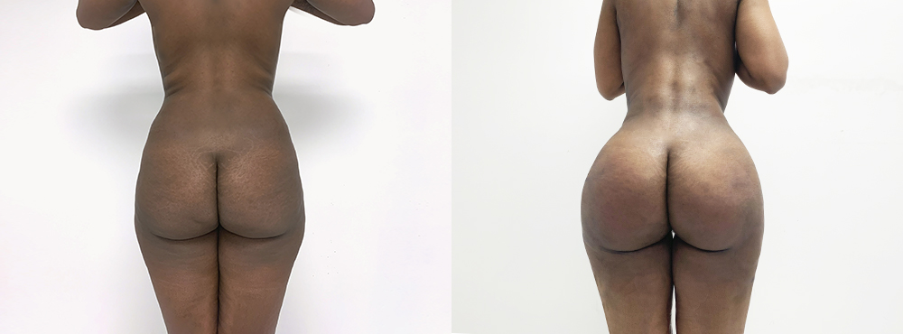 BBL Before and After