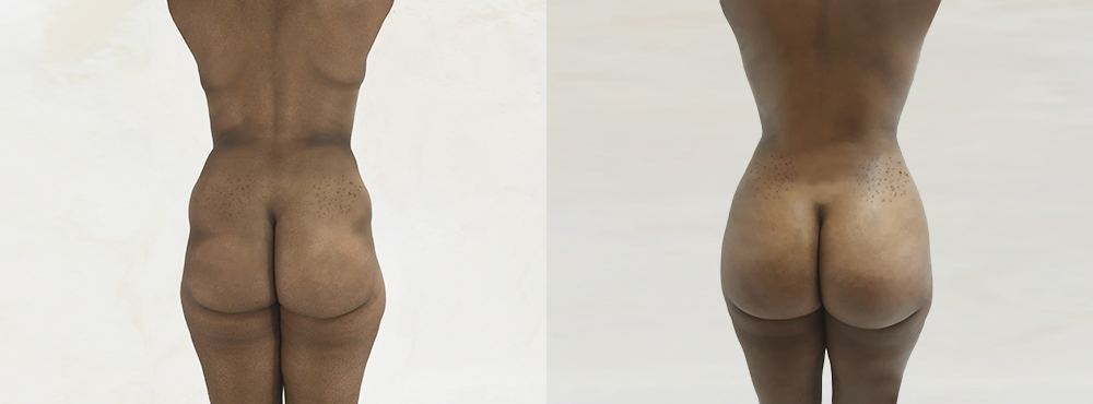 BBL Before and After