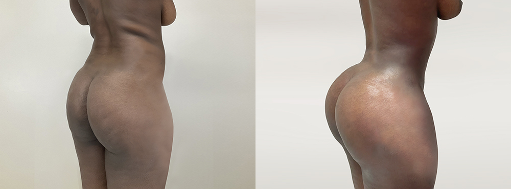 BBL Before and After