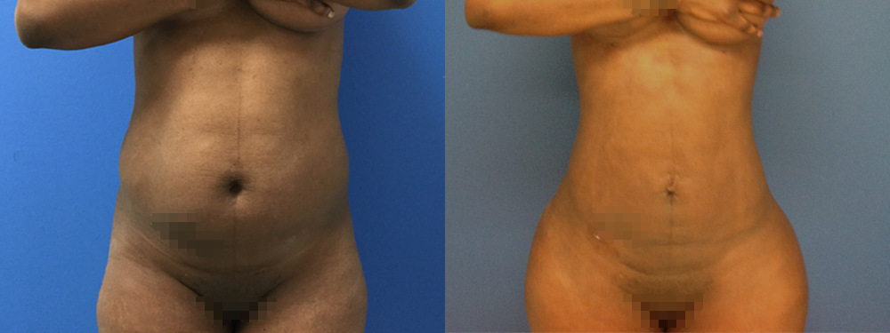 Brazilian Butt Lift Before and After