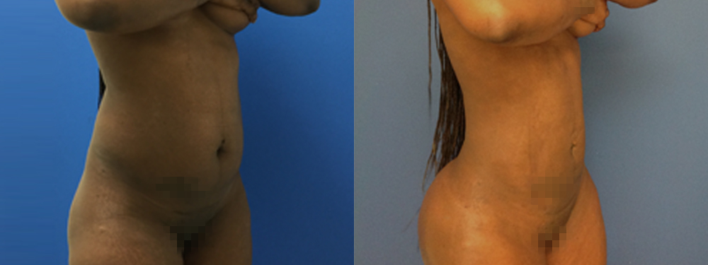 Brazilian Butt Lift Before and After