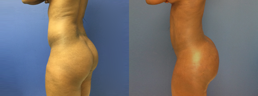 Brazilian Butt Lift Before and After