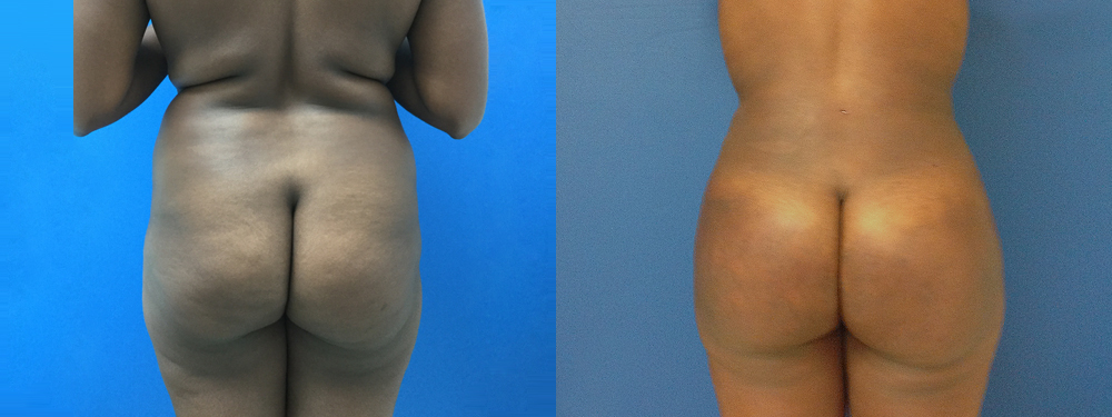 Brazilian Butt Lift Before and After