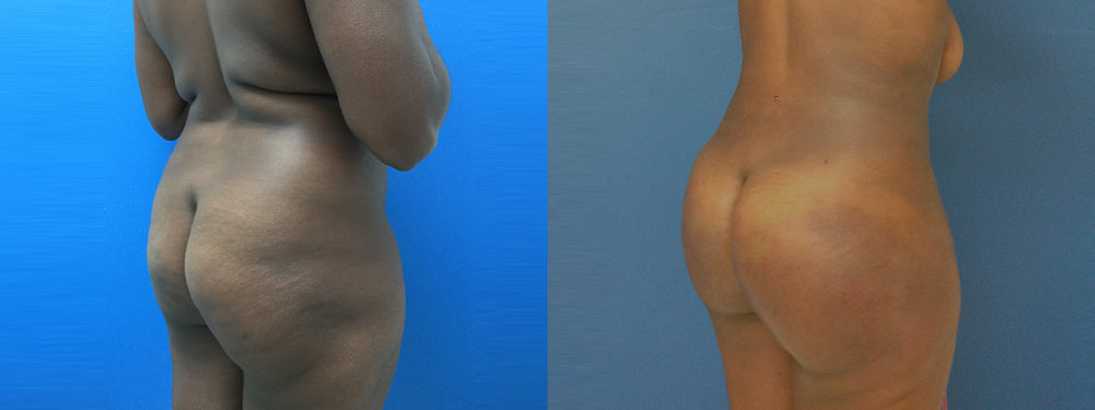 Brazilian Butt Lift Before and After
