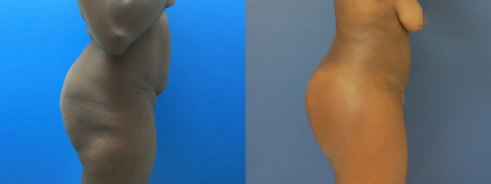 Brazilian Butt Lift Before and After
