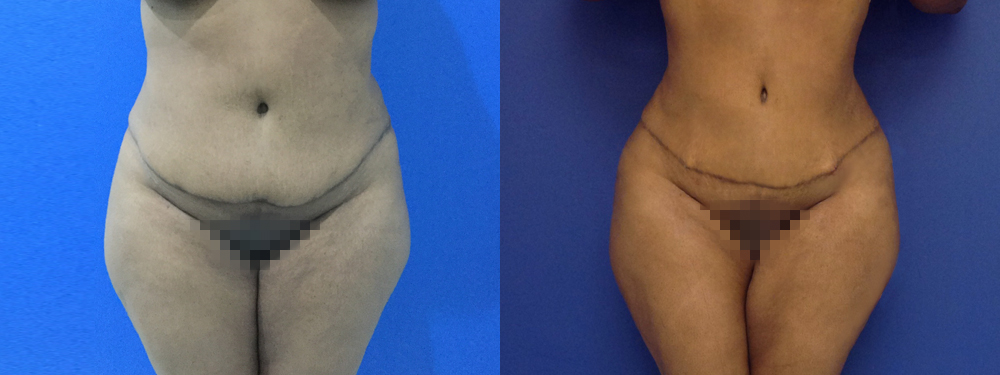 Brazilian Butt Lift Before and After