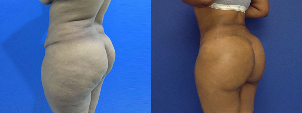 Brazilian Butt Lift Before and After