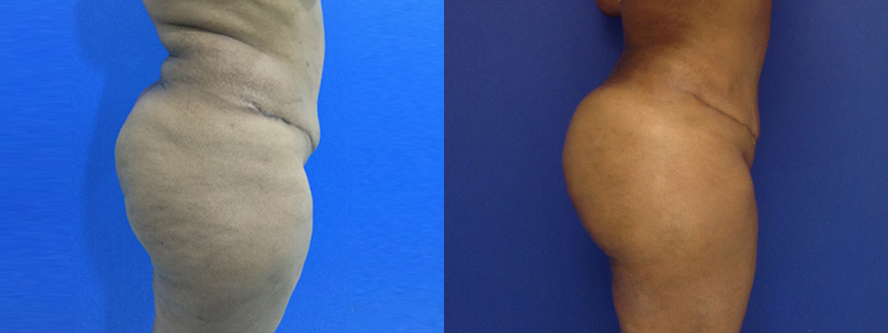 Brazilian Butt Lift Before and After