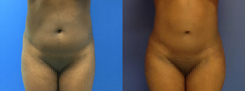 Brazilian Butt Lift Before and After