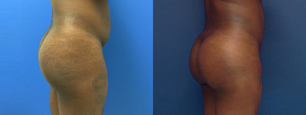Brazilian Butt Lift Before and After