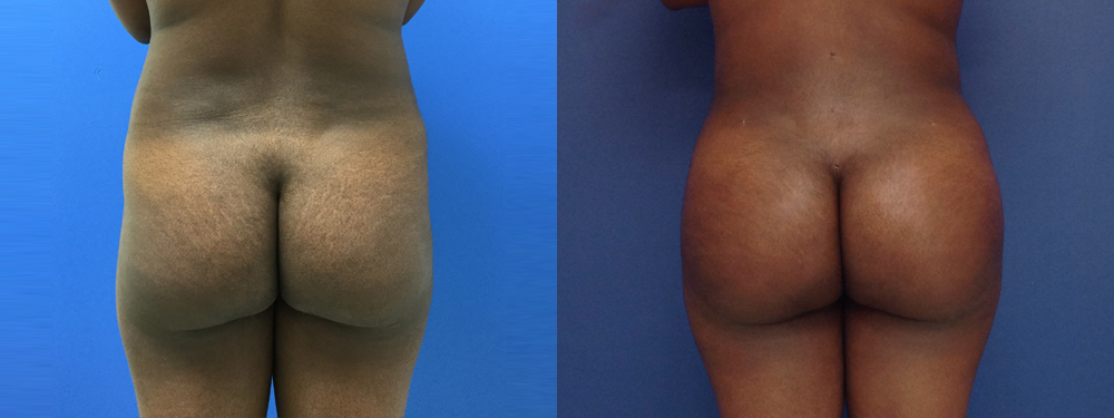 Brazilian Butt Lift Before and After