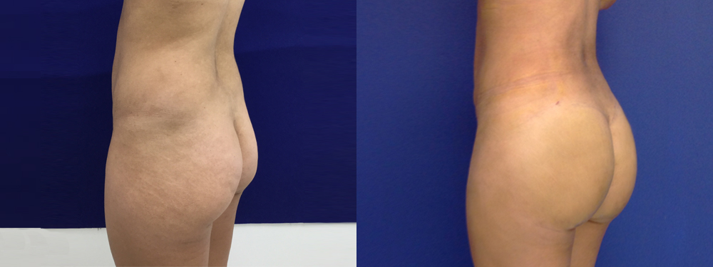 Brazilian Butt Lift Before and After