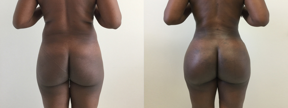 Brazilian Butt Lift Before and After