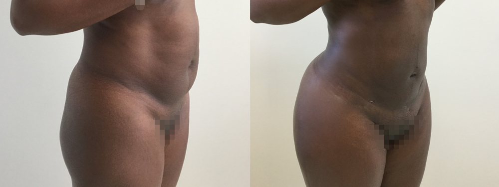 Brazilian Butt Lift Before and After