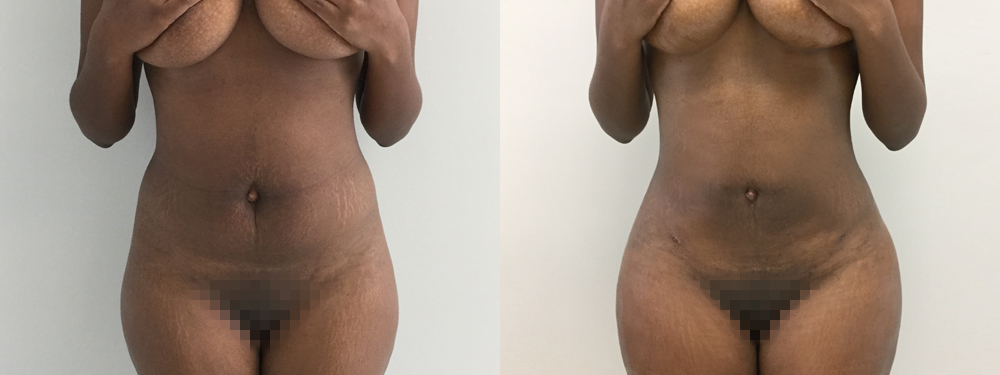 Brazilian Butt Lift Before and After