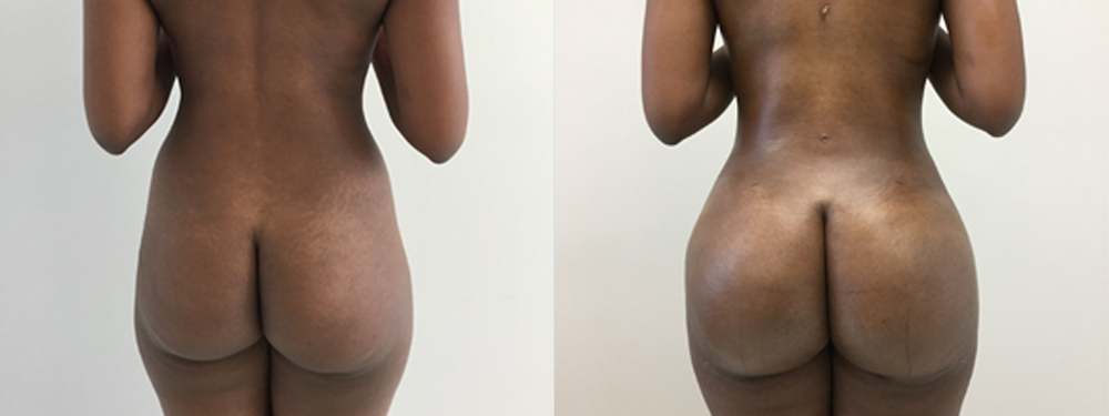 Brazilian Butt Lift Before and After