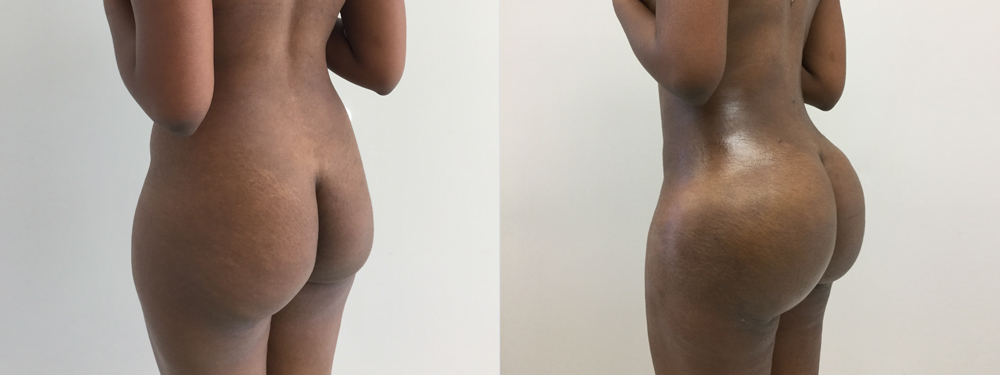 Brazilian Butt Lift Before and After