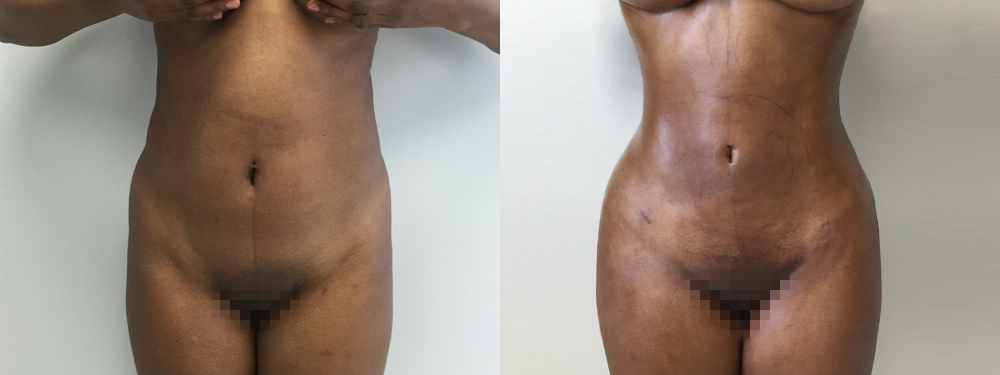 Brazilian Butt Lift Before and After