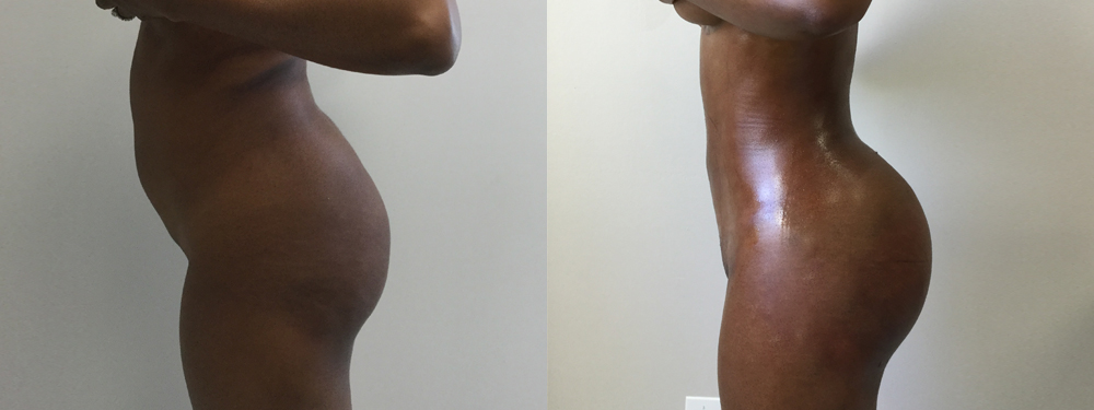 Brazilian Butt Lift Before and After