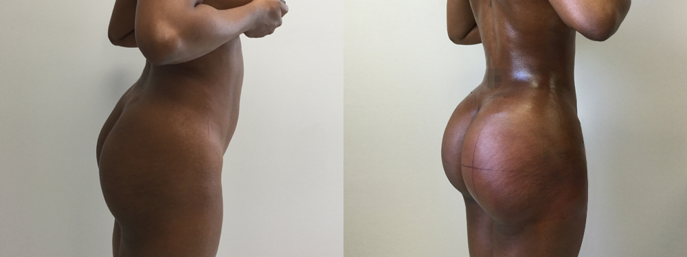 Brazilian Butt Lift Before and After