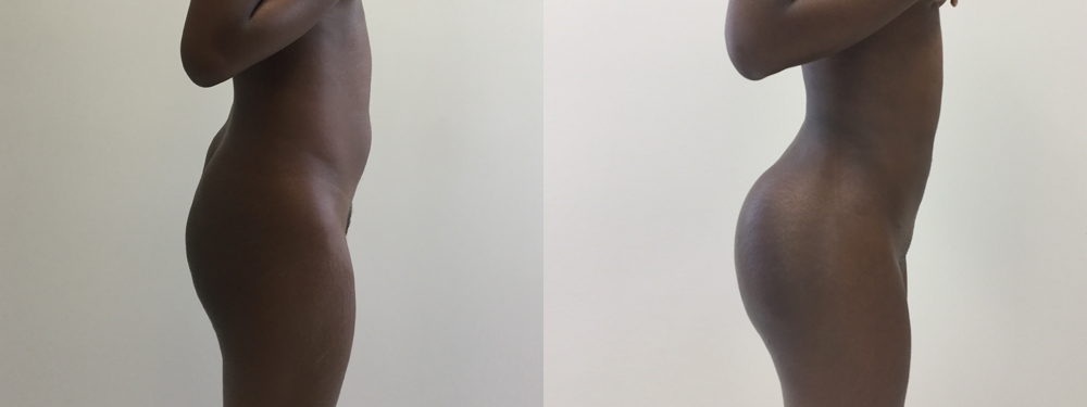 Brazilian Butt Lift Before and After