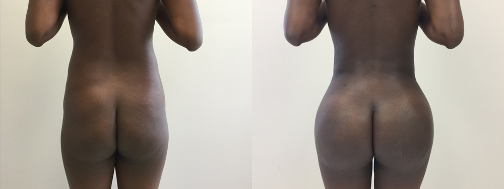 Brazilian Butt Lift Before and After