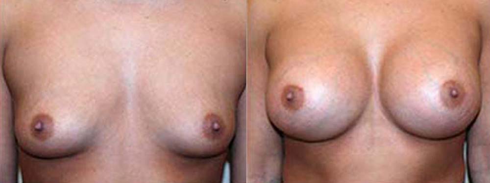 Breast Augmentation Before and After